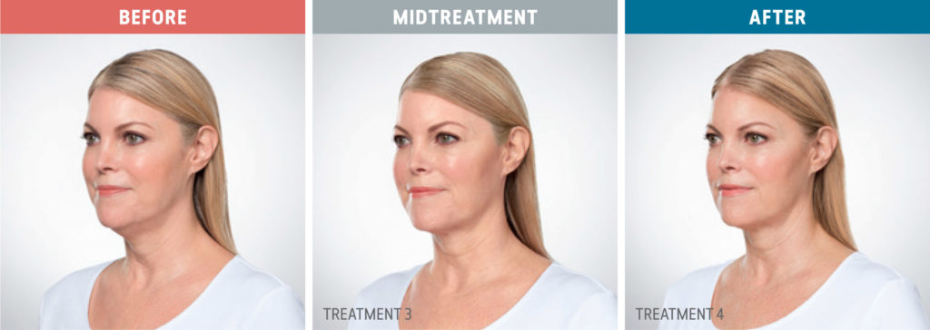 Kybella Before + After Photos - Purely Aesthetics